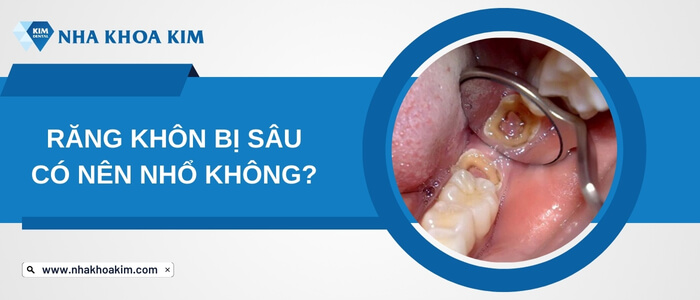 Răng khôn bị sâu có nên nhổ không?