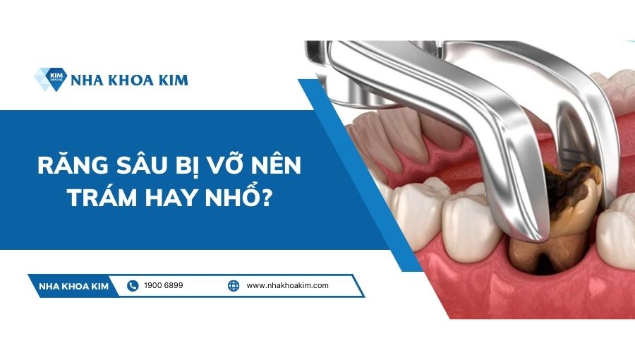 Răng sâu bị vỡ nên trám hay nhổ?