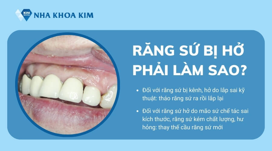 Răng sứ bị hở phải làm sao?