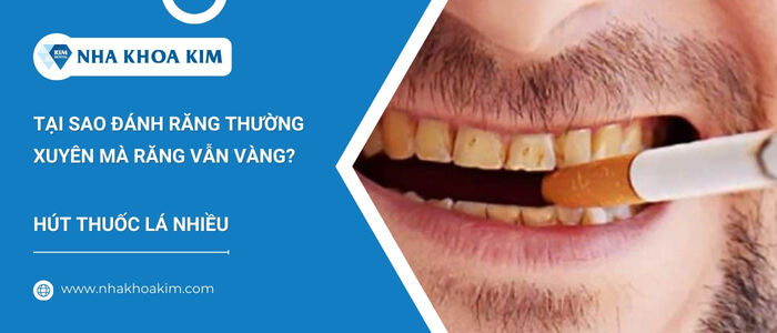 Vàng răng do hút thuốc lá nhiều