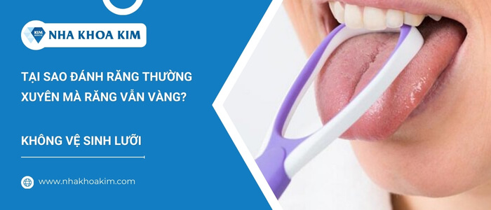 Răng vàng do không vệ sinh lưỡi thường xuyên