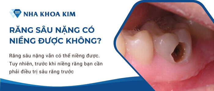 Răng sâu nặng có niềng được không?