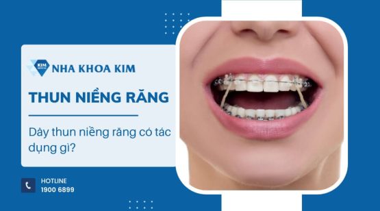 Dây thun niềng răng có tác dụng gì?