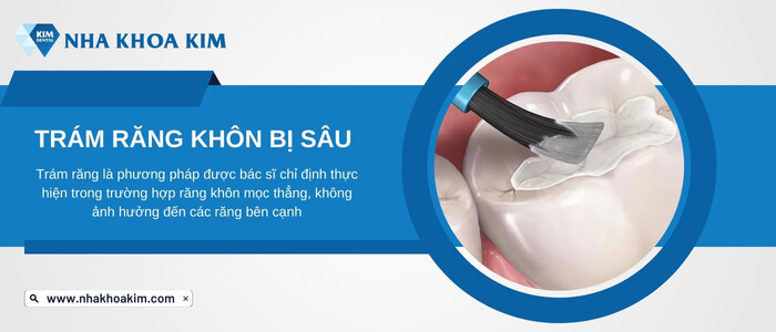 Trám răng khôn bị sâu