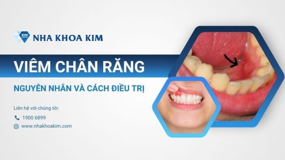 Viêm chân răng: Nguyên nhân và cách điều trị