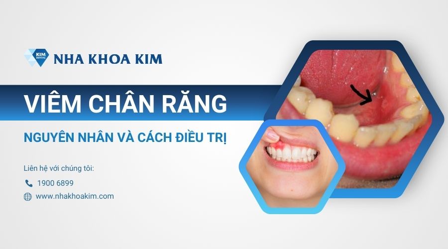 Viêm chân răng: Nguyên nhân và cách điều trị