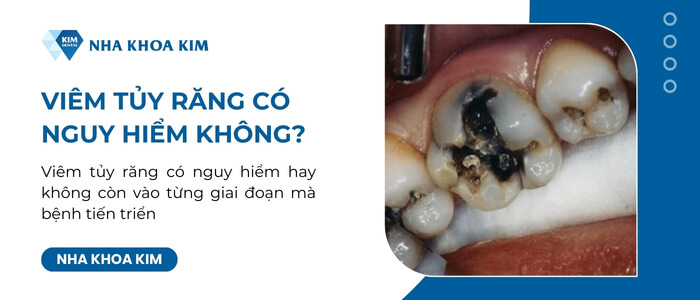 Viêm tủy răng có nguy hiểm không?