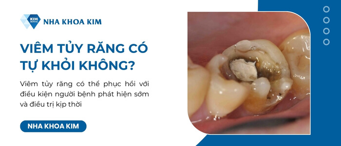 Viêm tủy răng có tự khỏi không?