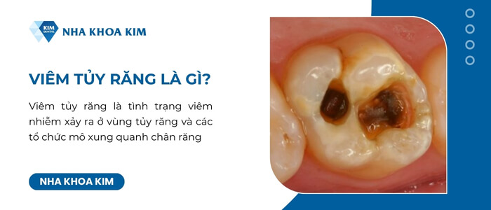 Viêm tủy răng là gì?