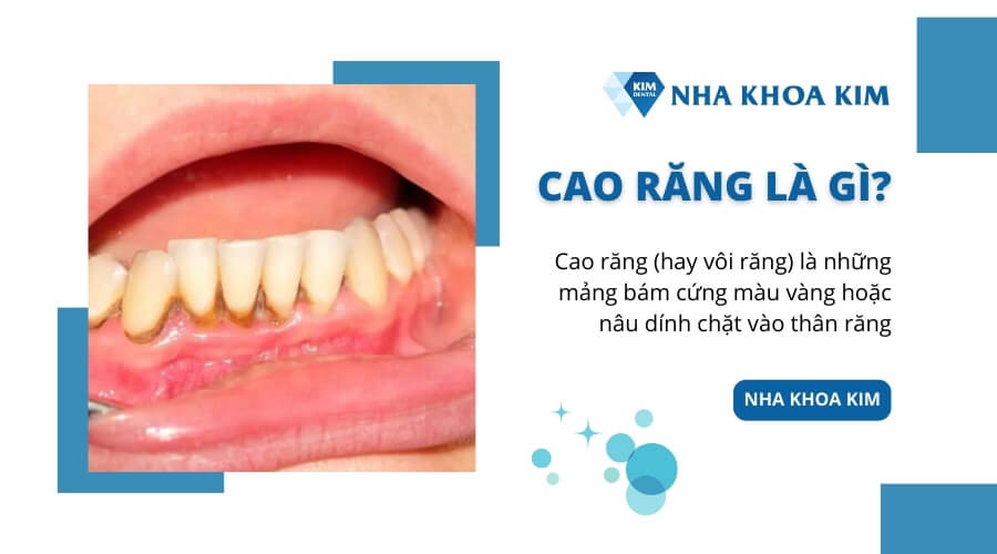 Cao răng là gì?