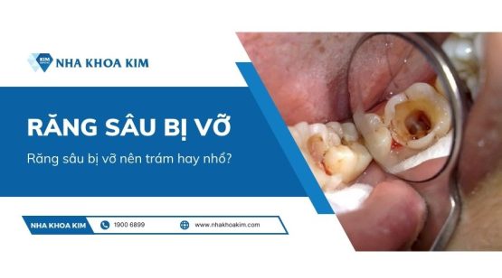 Răng sâu bị vỡ nên trám hay nhổ?