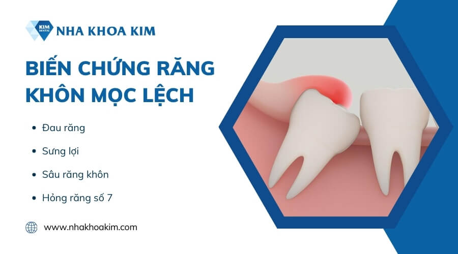 Răng khôn mọc lệch không nhổ có sao không?