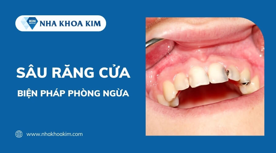 Biện pháp phòng ngừa sâu răng cửa