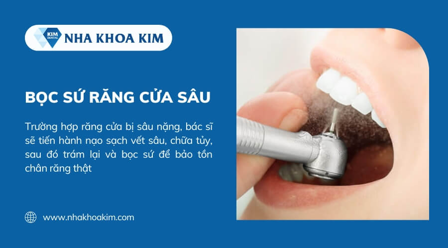 bọc răng sứ răng cửa bị sâu 