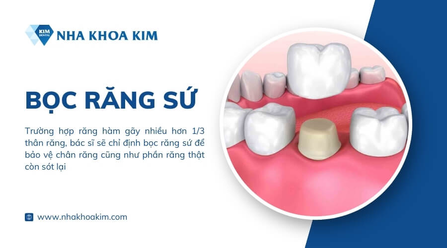 Bọc sứ cho răng hàm bị gãy