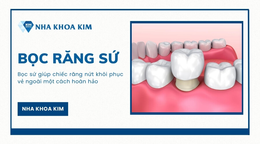 Bọc sức răng nứt