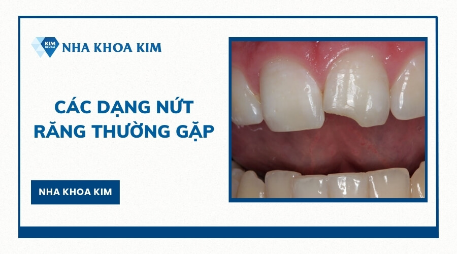 Các dạng nứt răng thường gặp