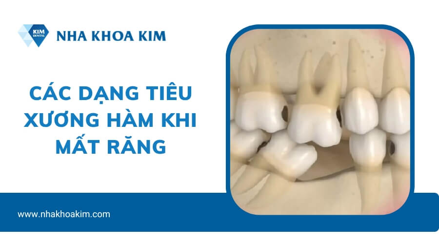 Các dạng tiêu xương hàm khi mất răng