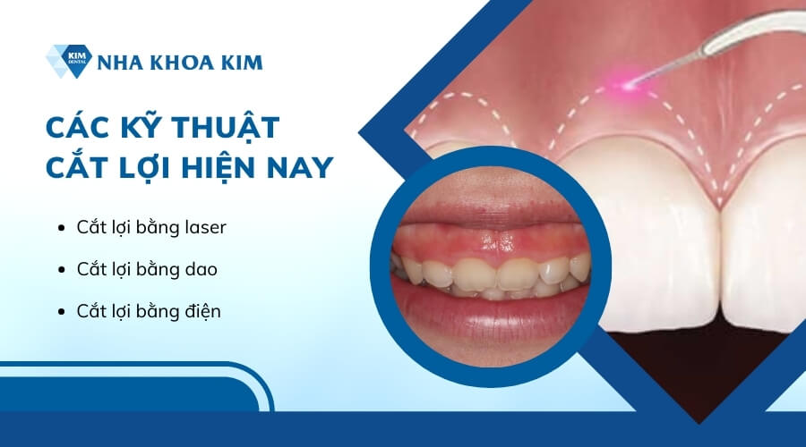 Các kỹ thuật cắt lợi hiện nay