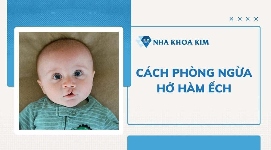 Biện pháp phòng ngừa hở hàm ếch