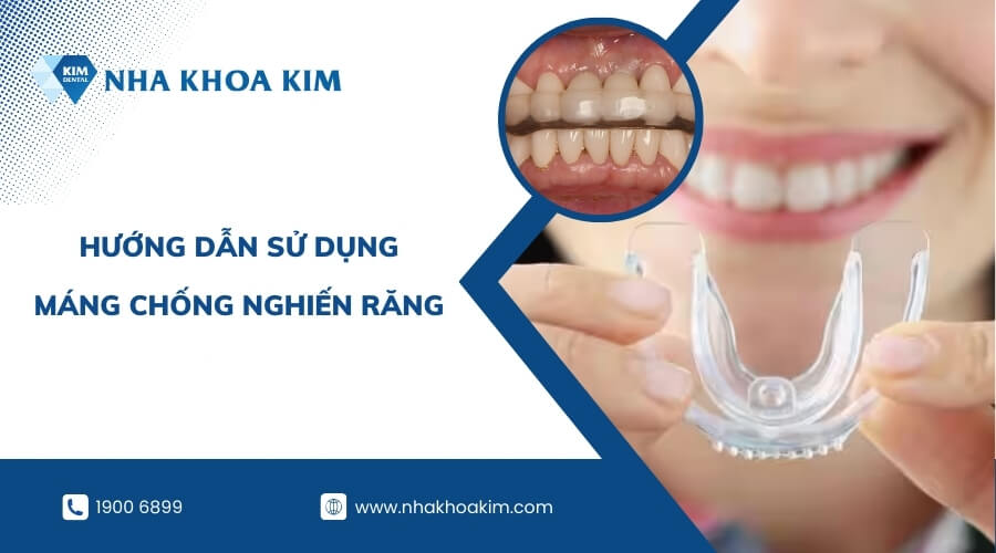 Cách sử dụng máng chống nghiến răng