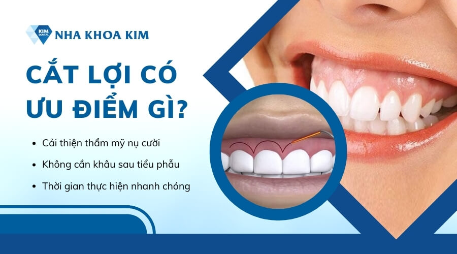 Có nên cắt lợi không?