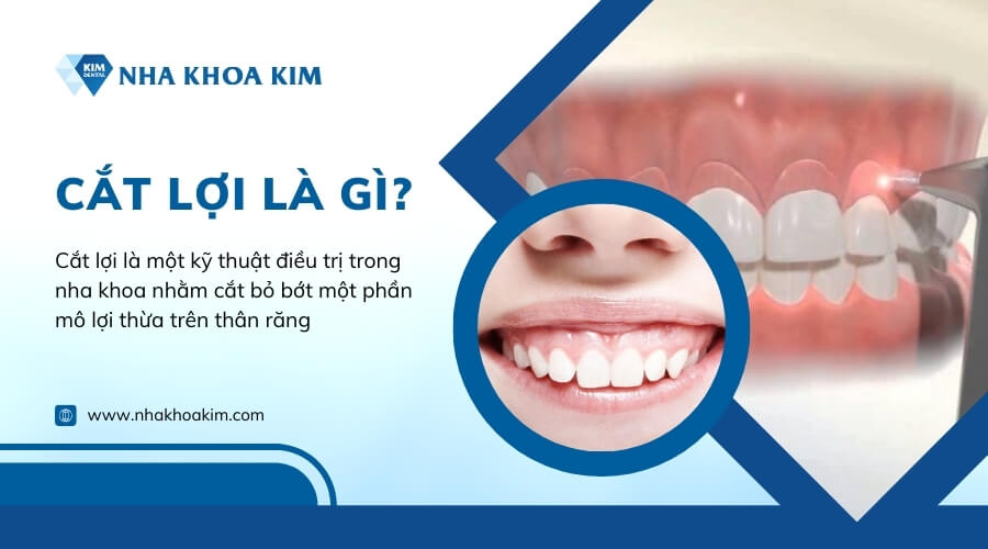 Cắt lợi là gì?