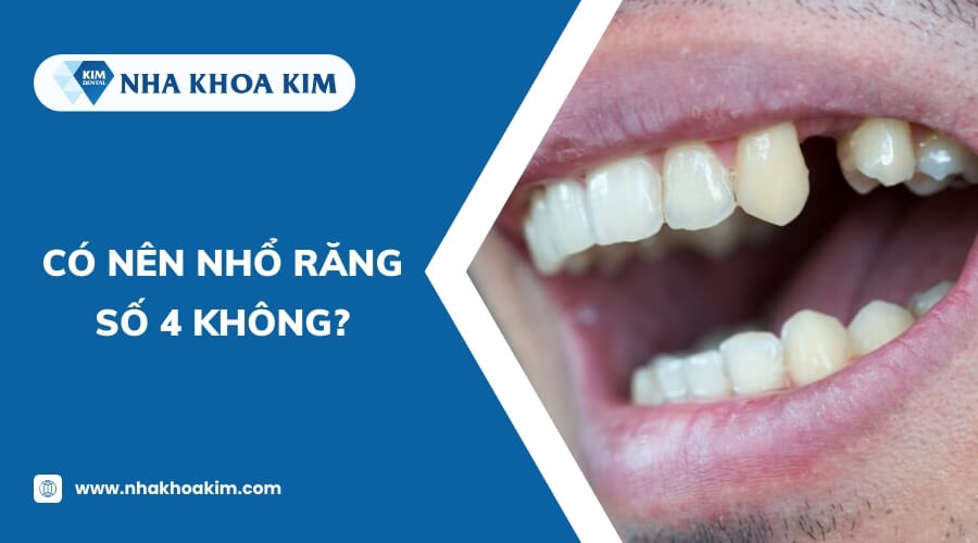 Có nên nhổ răng số 4 không?