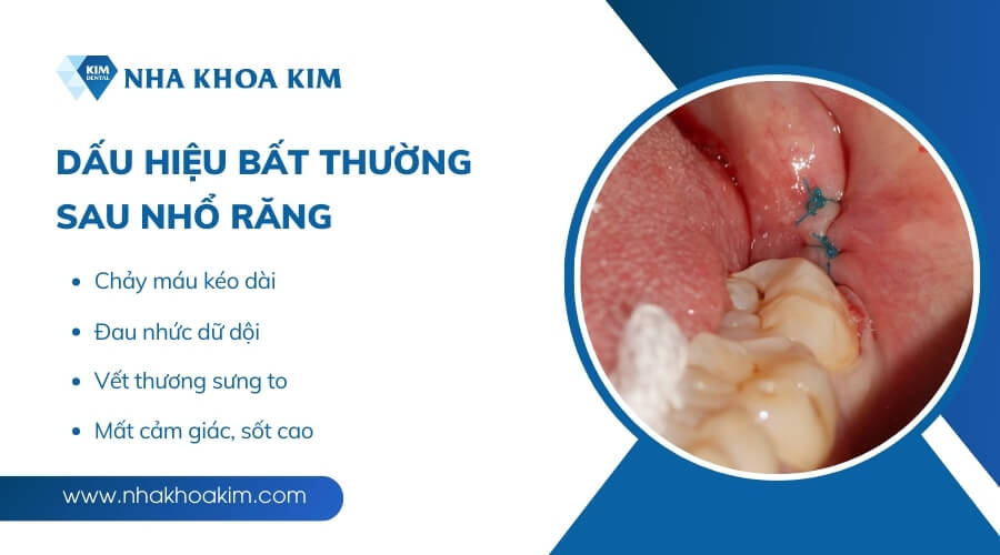 Các dấu hiệu bất thường sau nhổ răng cần lưu ý