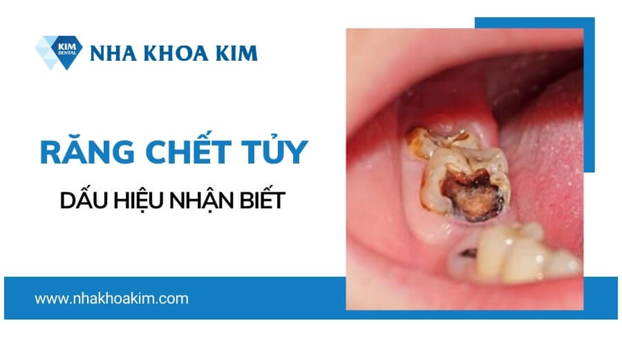 Dấu hiệu răng bị chết tủy