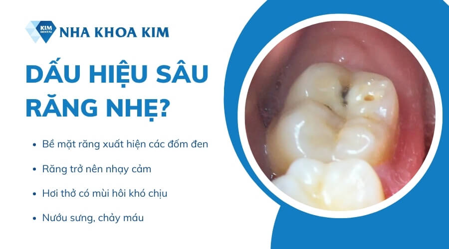 Dấu hiệu sâu răng nhẹ?