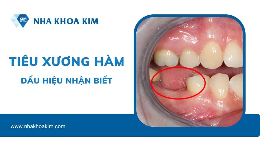 Dấu hiệu tiêu xương hàm