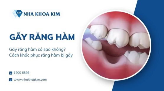 Gãy răng hàm có sao không? Cách khắc phục răng hàm bị gãy