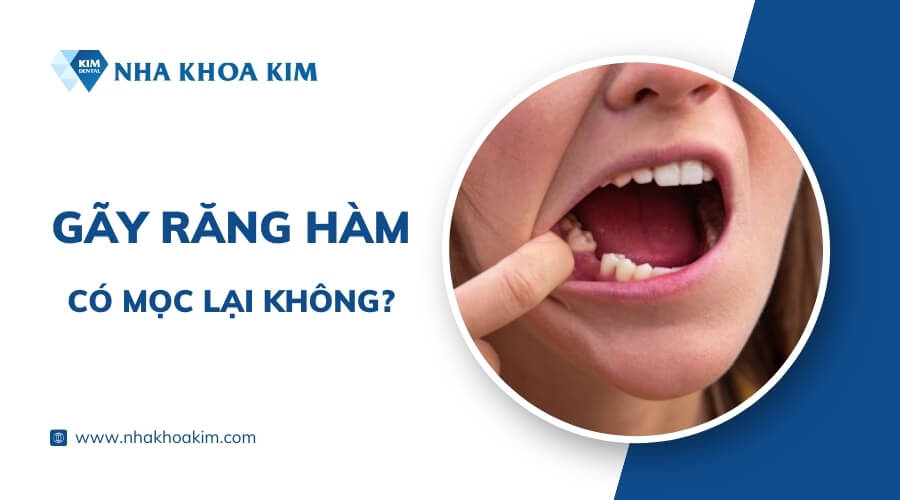 Gãy răng hàm có mọc lại không?