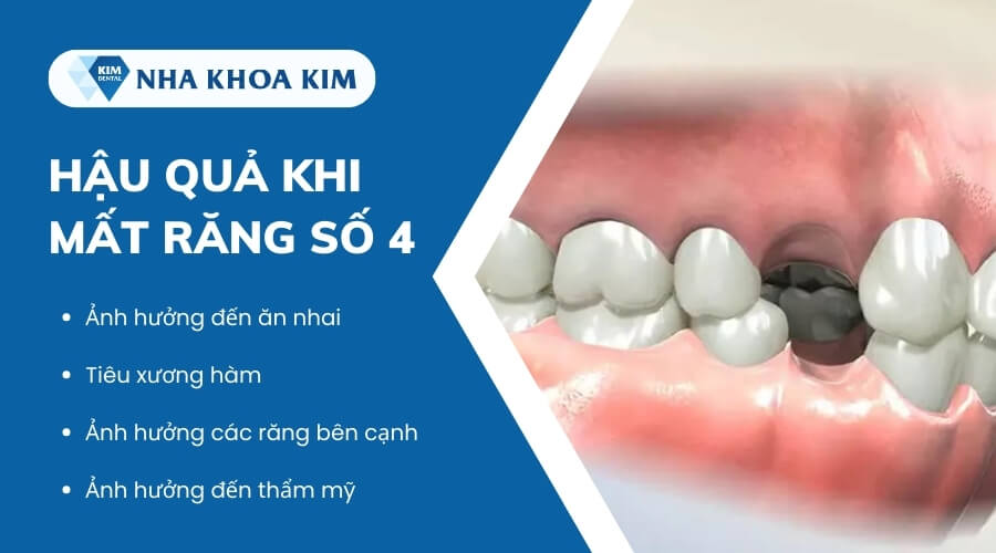 Tác hại của việc mất răng số 4