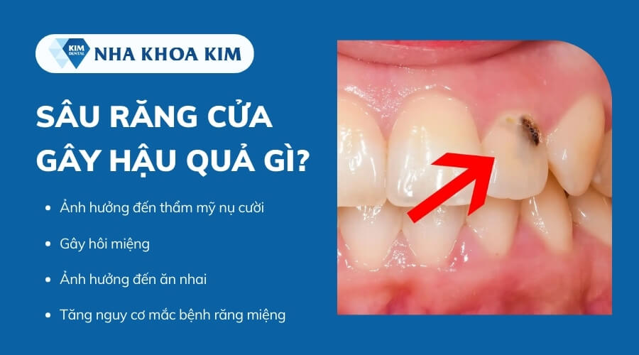 Răng cửa bị sâu có nguy hiểm không?