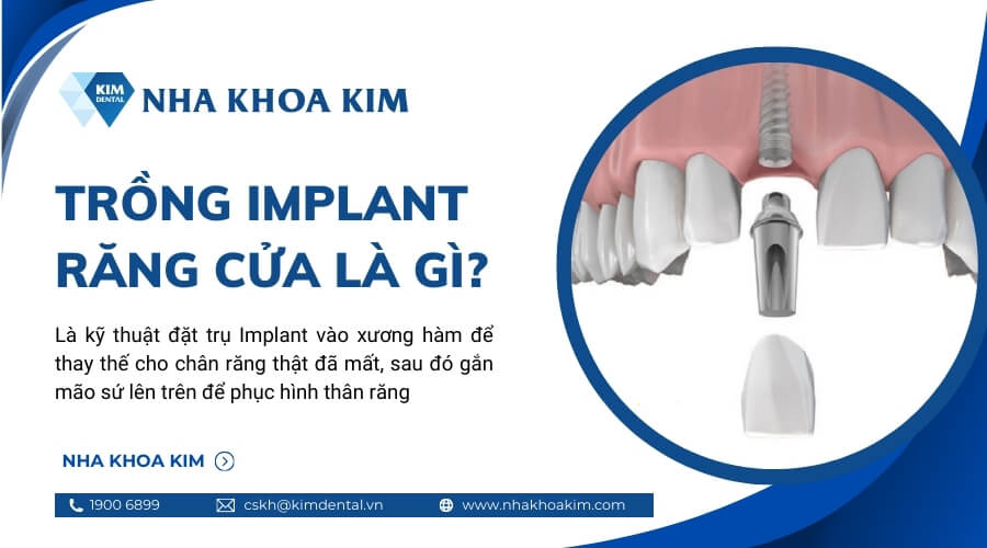 Trồng Implant răng cửa là gì?