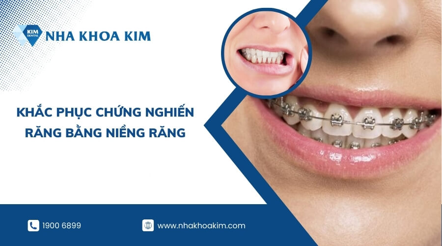 Các phương pháp điều trị thói quen nghiến răng khác