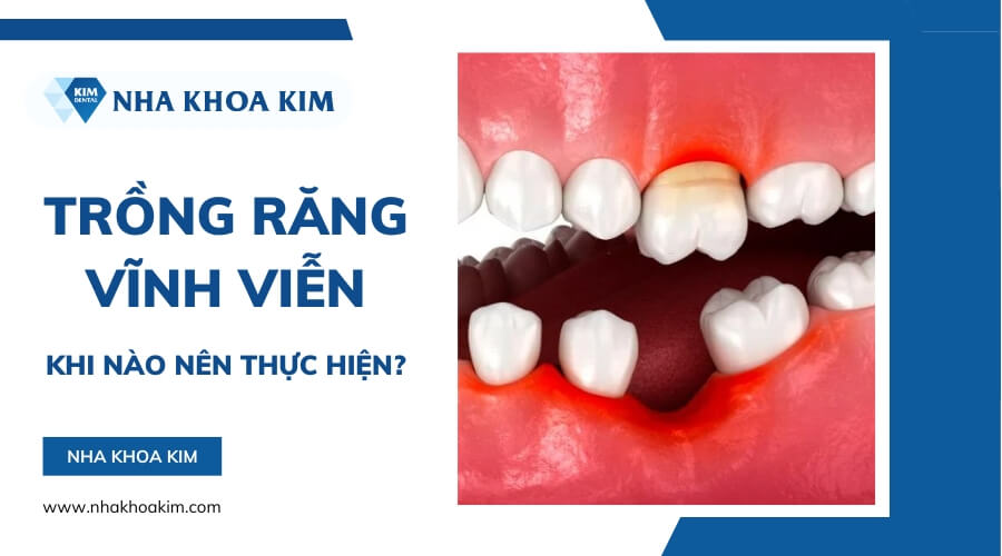 Trồng răng vĩnh viễn khi nào?