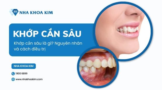 Khớp cắn sâu là gì? Nguyên nhân và cách điều trị