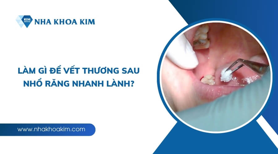 Làm gì để vết thương sau nhổ răng nhanh lành?