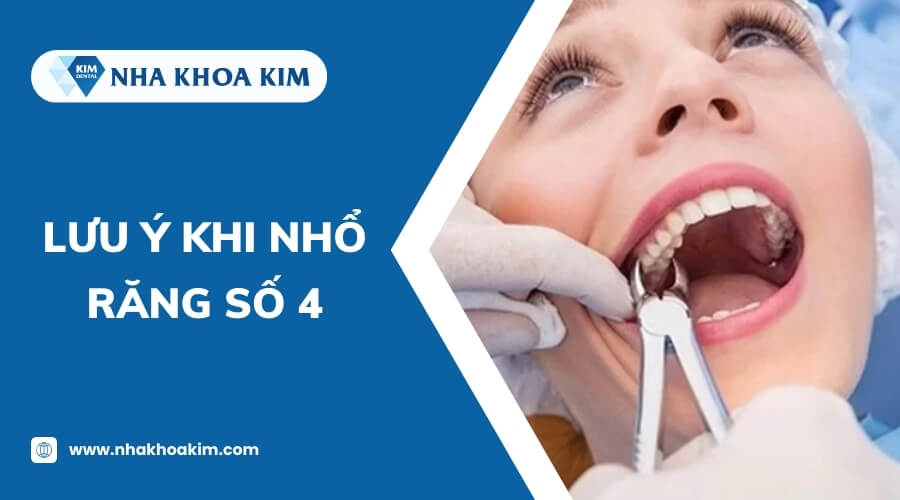 Lưu ý khi nhổ răng số 4