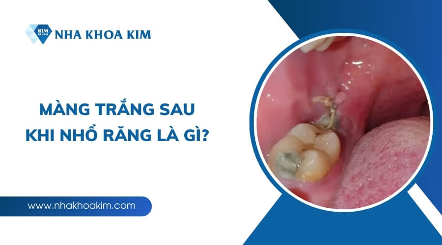 Màng trắng sau khi nhổ răng là gì?