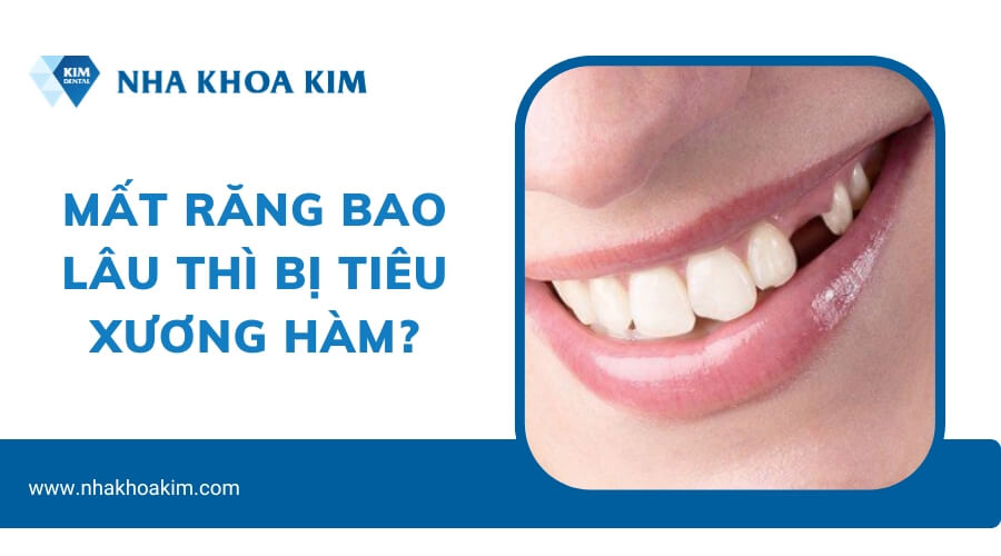 Mất răng bao lâu thì bị tiêu xương hàm?