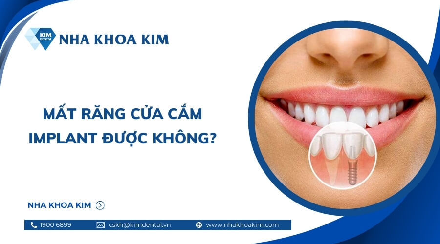 Mất răng cửa cắm implant được không?