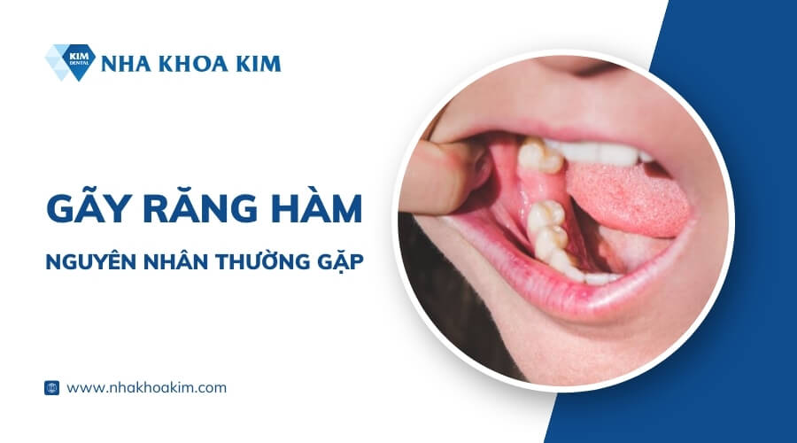 Nguyên nhân gãy răng hàm thường gặp