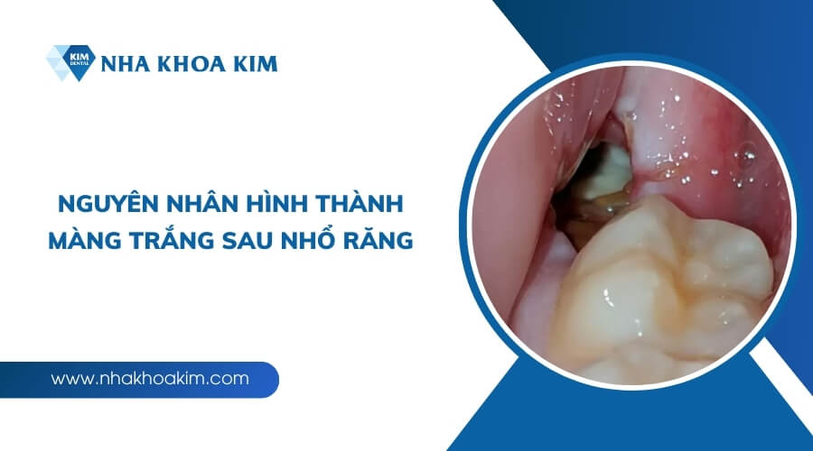 Nguyên nhân xuất hiện màng trắng sau khi nhổ răng