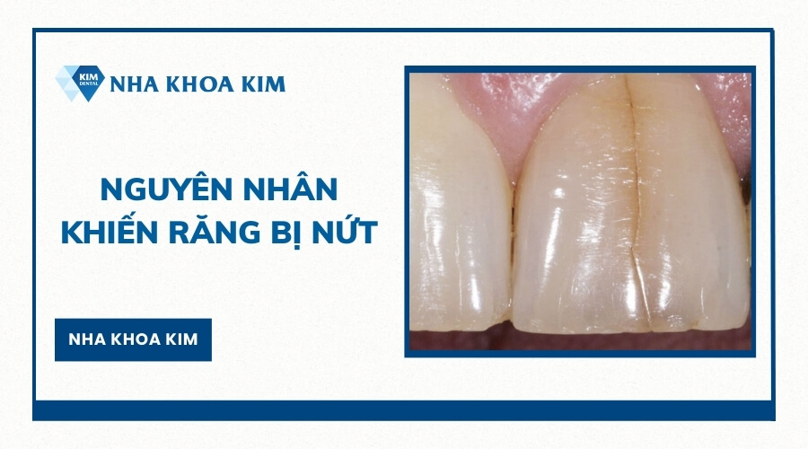 Nguyên nhân khiến răng bị nứt