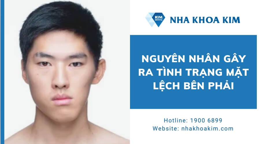 Nguyên nhân mặt lệch về bên phải?