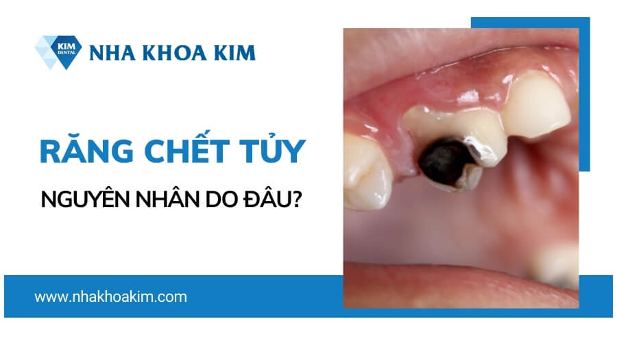 Tại sao răng bị chết tủy?